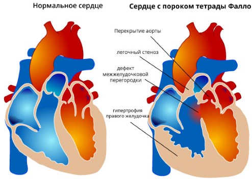 Сердце с пороком тетрады Фалло