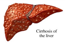Лечение цирроза печени в Израиле