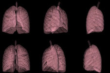 Сцинтиграфия лёгких