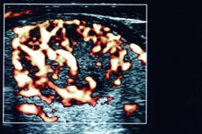 Сцинтиграфия щитовидной железы