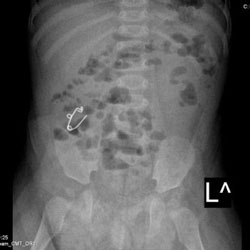 Извлечена открытая булавка из кишечника семимесячного ребёнка