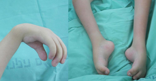 Ноги и руки Дениса до операции