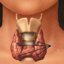 лечение рака щитовидной железы в Израиле