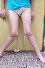 Х-образная деформация ног. Лечение деформации конечностей в Израиле
